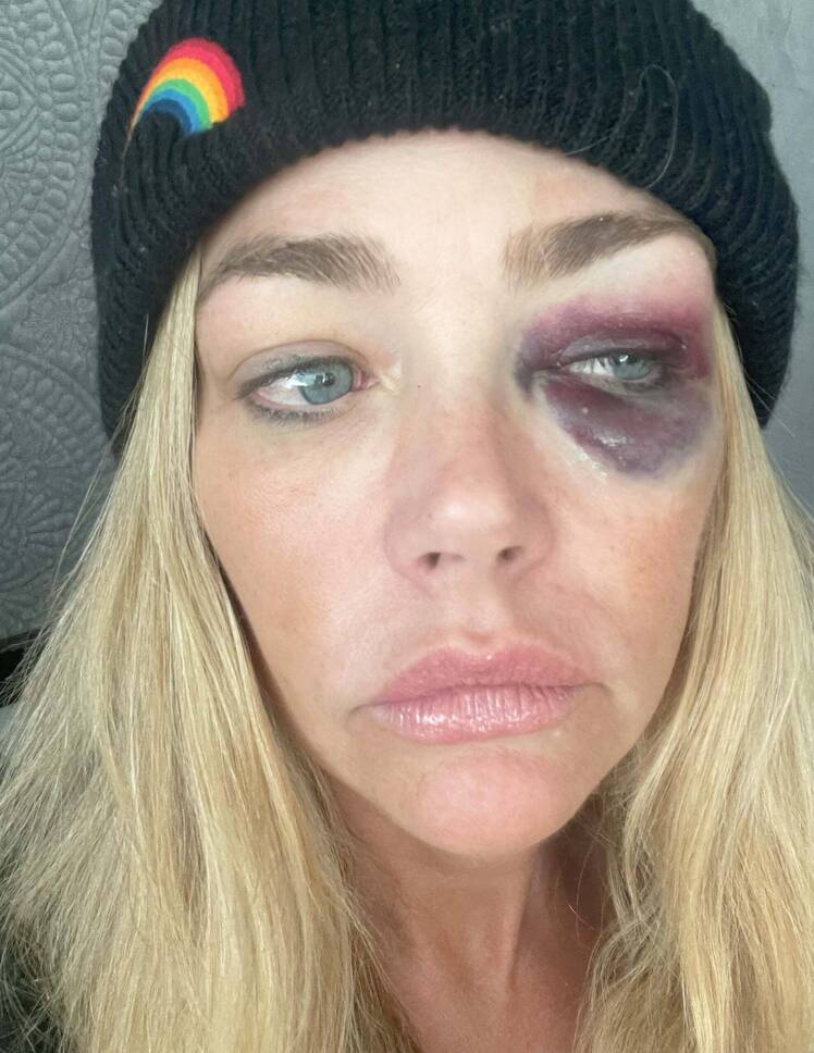 Denise Richards takes a close-up selfie wearing a black knit hat with a rainbow patch, showing a large bruise and swelling around her left eye.